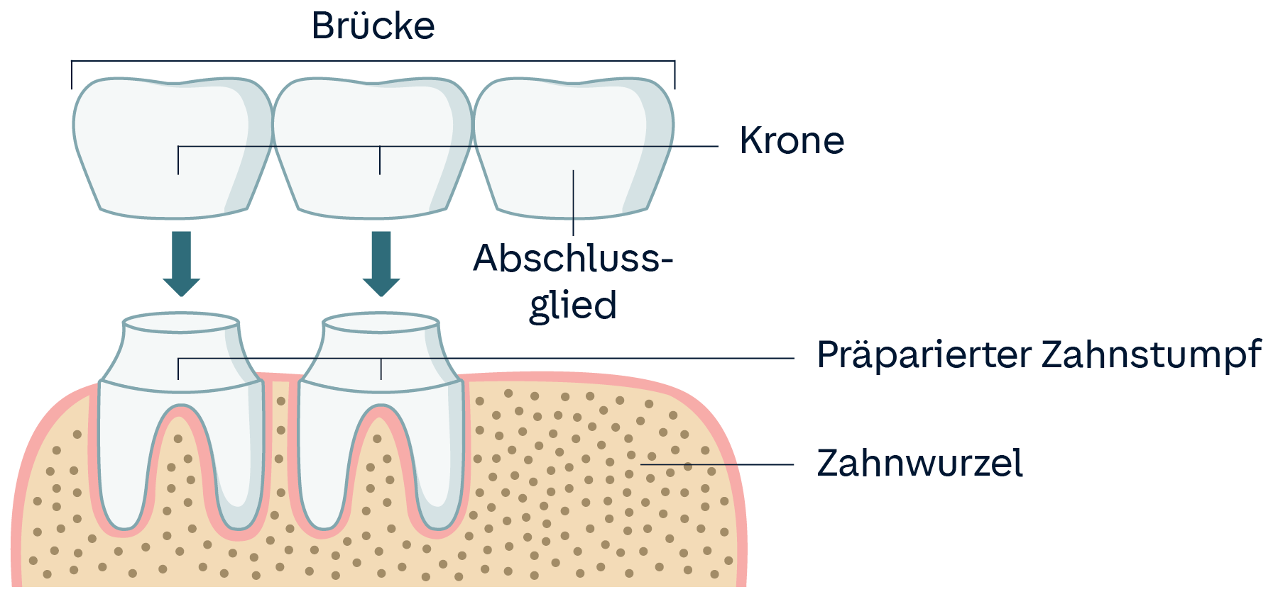 Schematische Darstellung einer Freiendbrücke, bei der ein Abschluss der Brücke auf keiner Wurzel sitzt, das Ende also frei hängt.