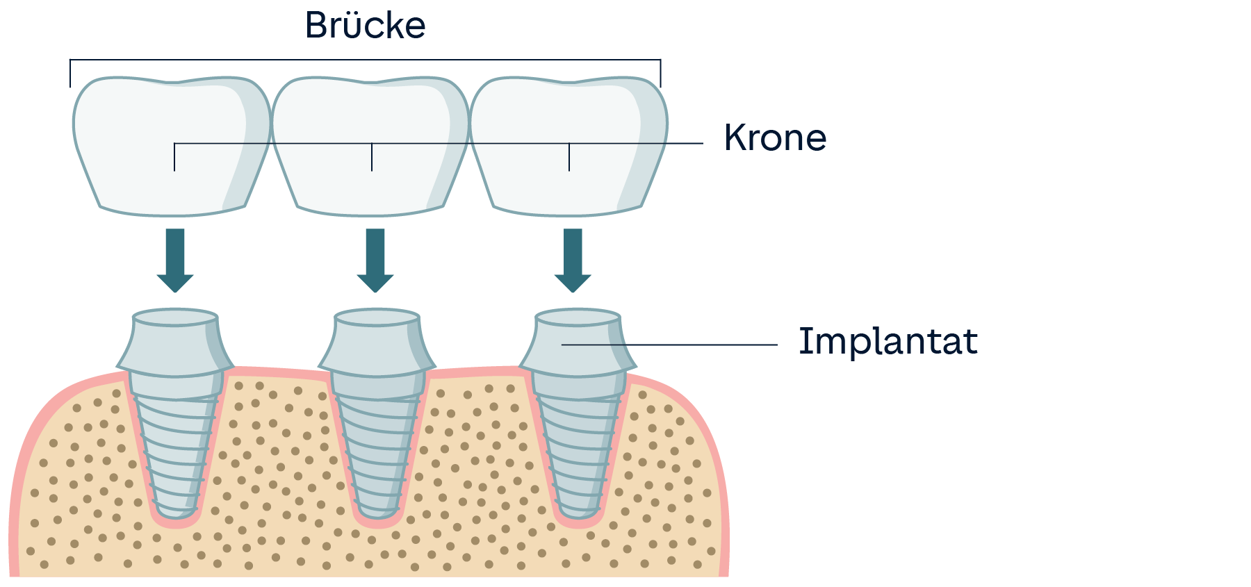 Schematische Darstellung einer Implantatbrücke, bei der jede Krone auf einem Implantatstift sitzt.