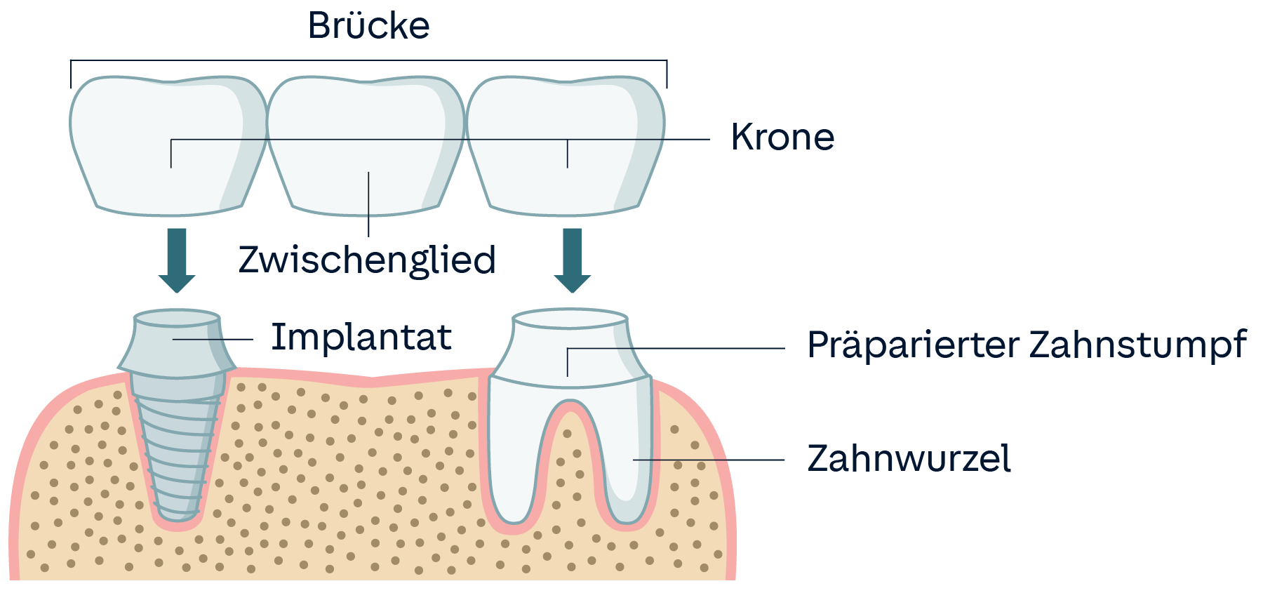 Infografik: Verbundbrücke, bei der eine Krone auf einem Implantat sitzt und eine auf der Wurzel.