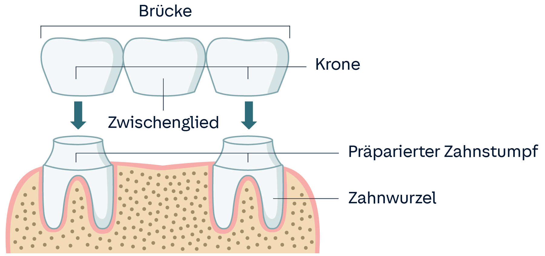 Grafik Zahnbrücke