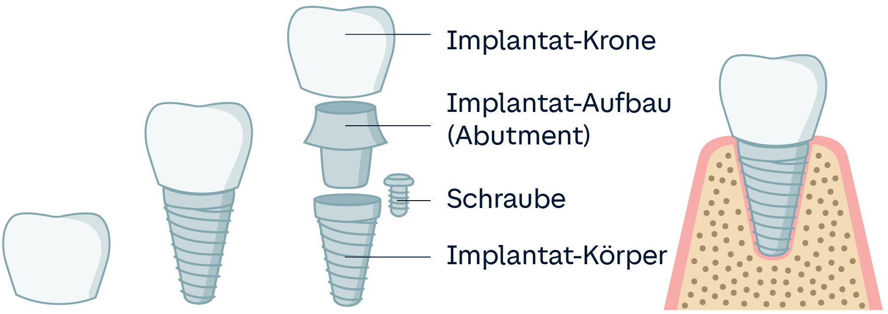 Infografik: Teile eines Zahnimplantats mit Krone, Abutment, Schraube und Körper