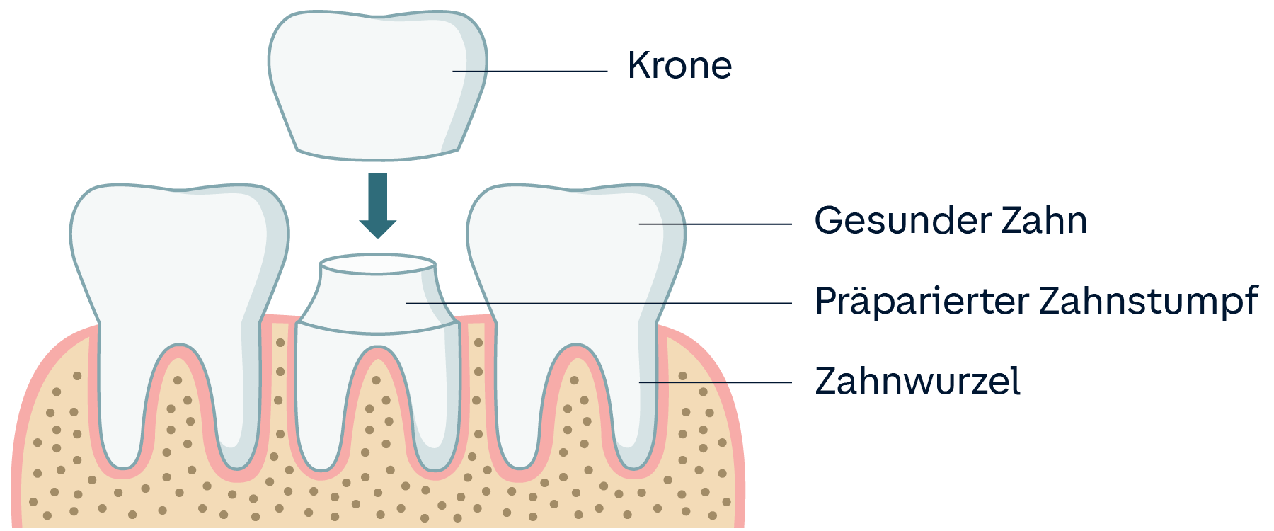 Grafik Zahnkrone